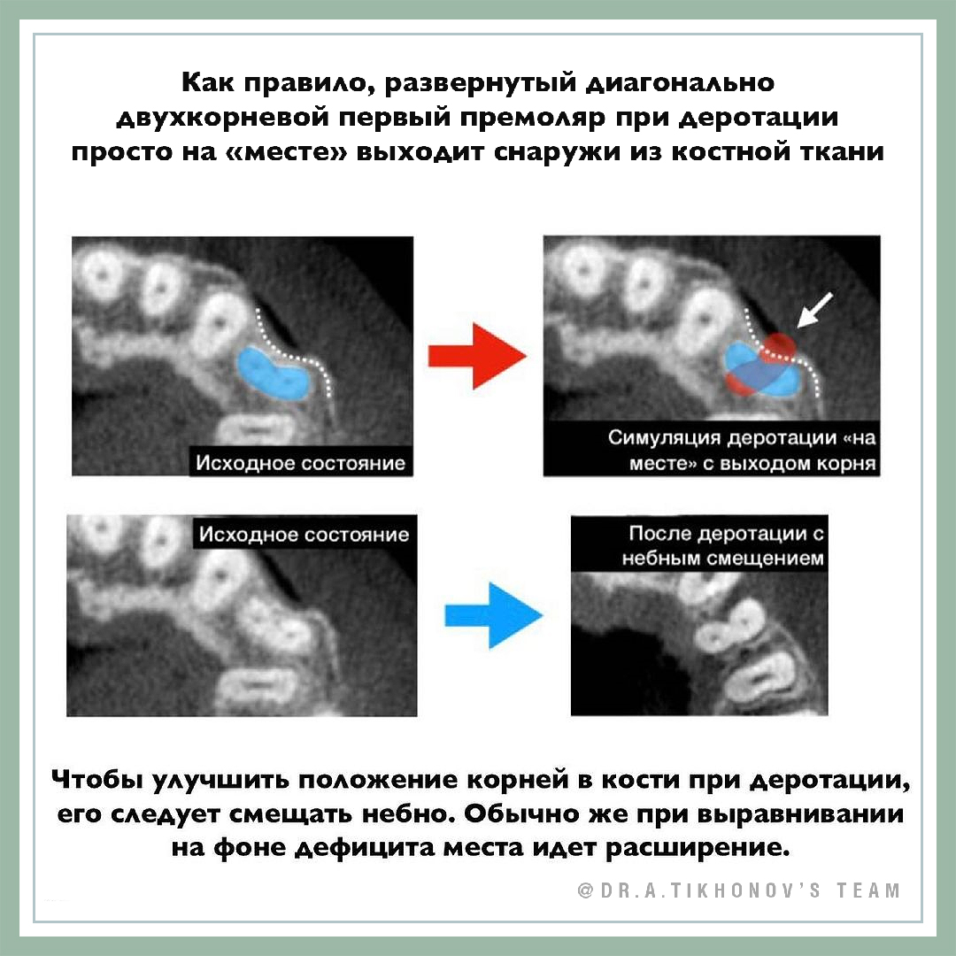 История «спасения» одного премоляра. - интересно об ортодонтии, имплантации  и протезировании зубов